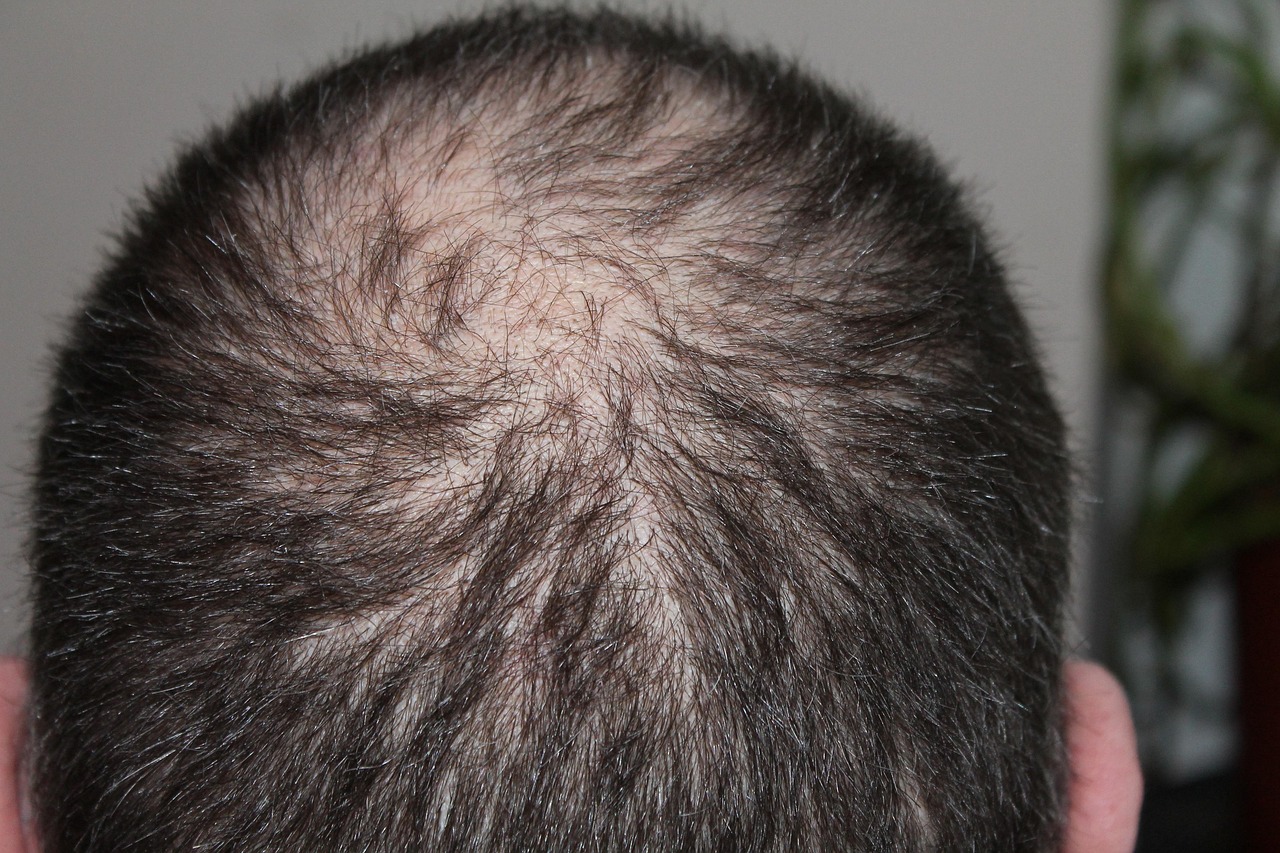 医療脱毛でハイジニーナを実現する完全無毛の方法は？